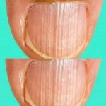 Having striped nails might mean that your body is……. Read full story in comment