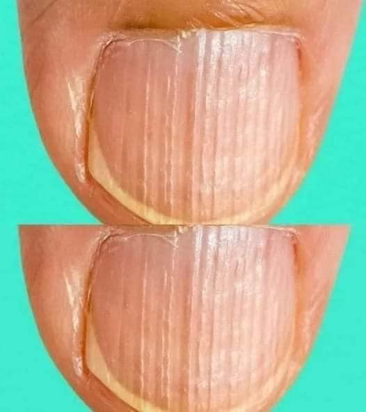 Having striped nails might mean that your body is……. Read full story in comment